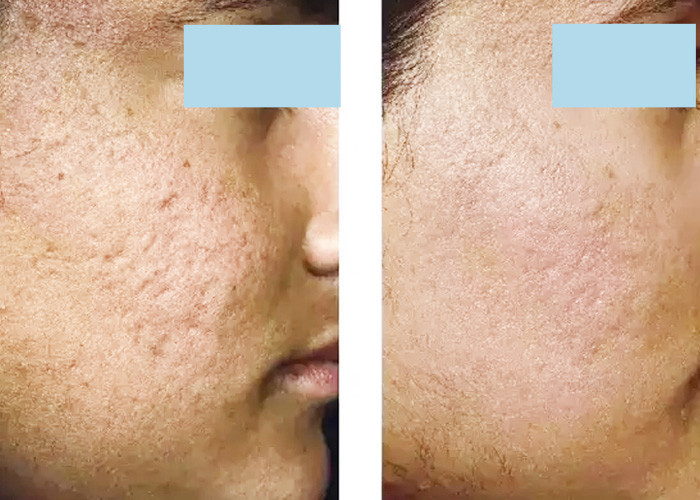 Face Neck Hands Fractional Laser Machine 30mJ Laser Skin Resurfacing Machine
