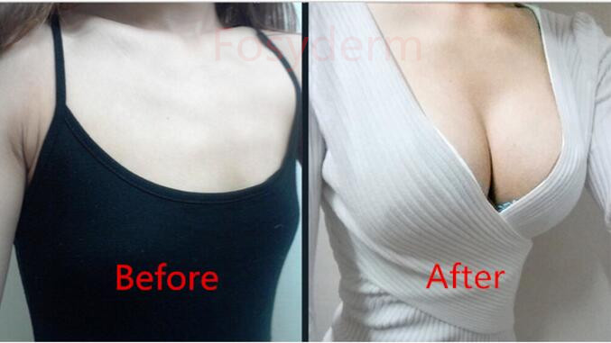 Hyaluronic Acid Breast Filler 10ml , Women Breast Augmentation Injection Filler