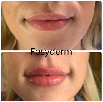 1ml 2ml 10ml Injectable Dermal Filler , Cross Linked Hyaluronic Dermal Fillers Ha
