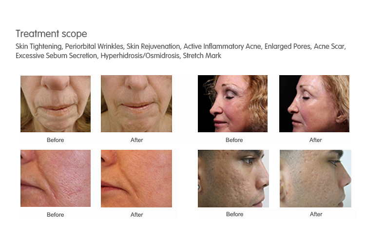 2019 online order free shipping acne removal ，skin rejuvenation Fractional RF Treatment Machine with microneedle