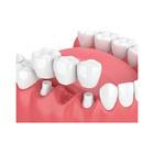 Quality Comfortable Dental Crowns And Bridges Strong Wear Resistance Make Smile Sweeter wholesale