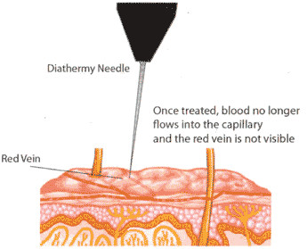 Laser treatment for varicose veins Best treatment for varicose and spider veins