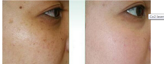 White Most Effective Co2 Fractional Laser Machine Acne Scar Removal