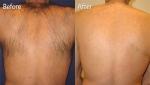 Stationary Style Diode Laser Hair Removal Machine With Painless Treatment