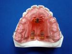 Custom Removable OEM Fixed Orthodontic Appliance Good Durability