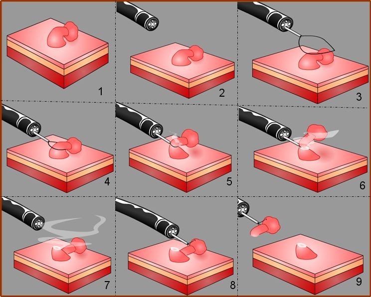 Cold snare polypectomy and hot snare polypectomy