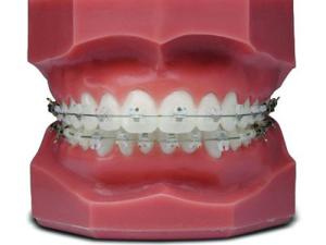 Quality Comfortable Fixed Orthodontic Appliances Beautiful Natural Ceramic Brackets wholesale