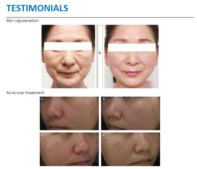 Femilift Laser Vaginal Rejuvenation Co2 Fractional Laser Machine CE Approved