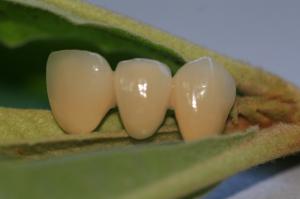 Quality ISO13485 Good Biocompatibility PFM Non Precious Dental Crown wholesale