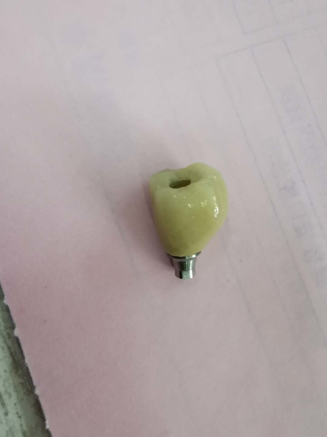 Great Biocompatibility ANKYLOS Dental Implant Supported Crown