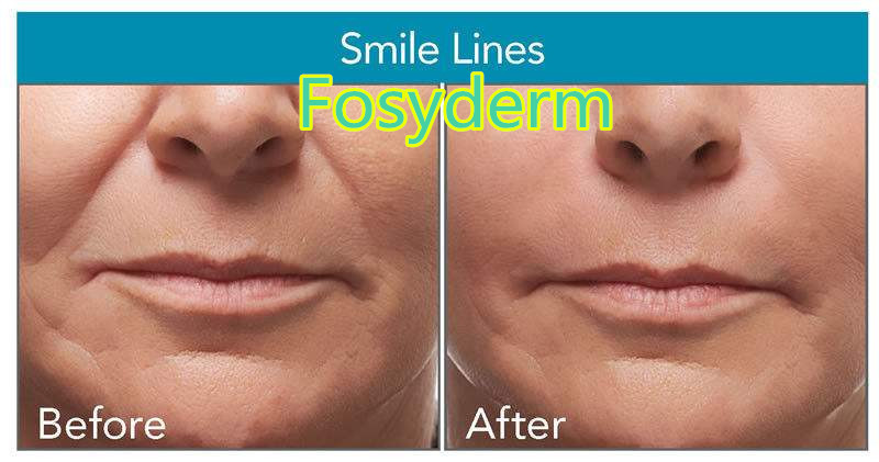 Odm Oem Hyaluronic Acid Facial Filler Gel Injection 6 - 18 Months Duration