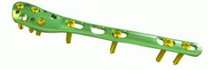 Quality Orthopedics Distal Fibula Locking Plate Trauma Fixation Devices wholesale