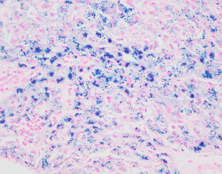 Hemosiderin Stain (Potassium Ferrocyanide) Baso Clear Colourful Stains