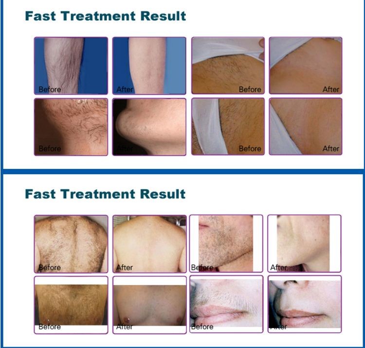 Alexandrite Stationary DPL Laser Hair Removal 808nm Alma Hair Removal Laser