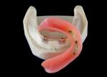 All-On-4 Titanium CNC Implant Secured Dentures For Dental Clinic