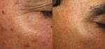 Custom Q Switch ND Yag Laser Machine For Tattoo Removal / Acne Treatment
