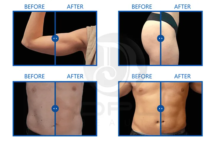 2023 Body Slimming Inner Ball Lymphatic Drainage 9D Rotation Vacuum Suction Cup Roller Cellulite Removal Skin Firm
