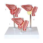 Human Anatomy PVC Simulation Human Pathology Prostate Model For Medical