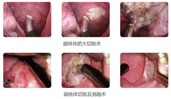 Cryogenic Radio Frequency Plasma Surgery System Minimal Invasive
