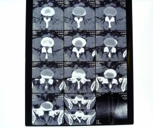 Quality 8in* 10in 14in * 17in High Density Medical X-ray Dry Thermal Printer Film wholesale