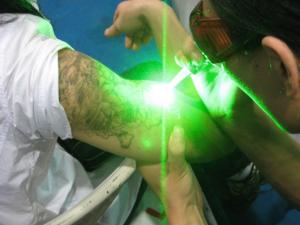 Quality Dermatology Neodymium picolaser Nd Yag Laser 1064nm Portable wholesale