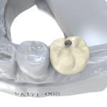 Long-Lasting Low Water Absorption Permanent Crown Resin for Porcelain-Filled