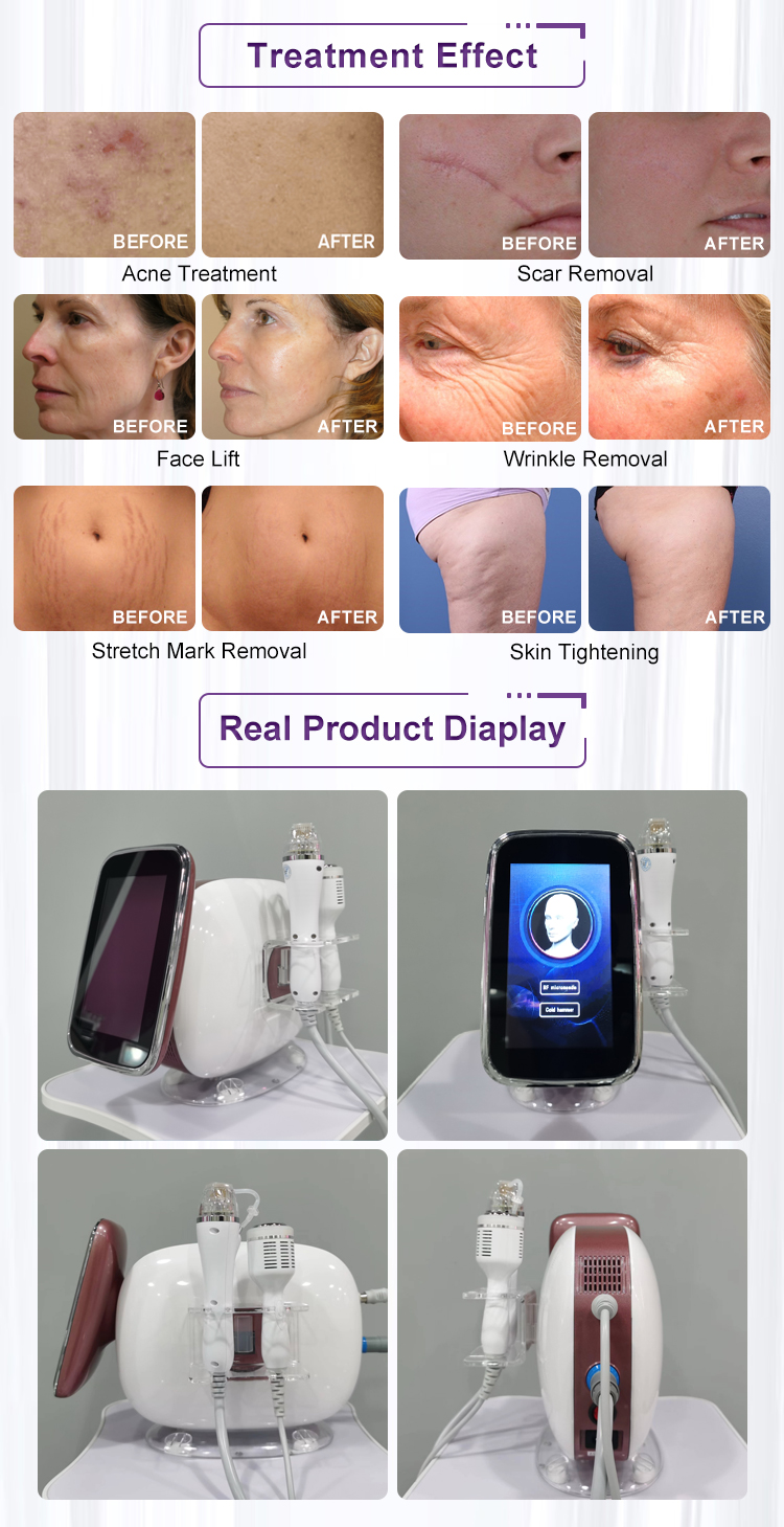 Gold Micro Needling With Radio Frequency Fractional Portable Rf Microneedling Machine For Face Beauty Device