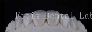 Quality Smooth Polished Ceramic Laminate Veneers In Dentistry Smile Creators wholesale