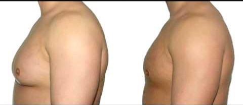 16W Laser Lipolysis Machine Gynaecomastia Treatment Minimally Invasive