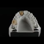 Porcelain Ceramic PFM Dental Crown Material For Restoration