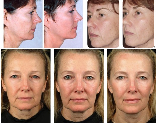 Most effective High Quality Thermage Skin Treatment Machine for Skin Treatment