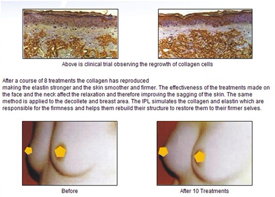 Clinic Face Rejuvenation IPL Hair Removal Machine , Wrinkles Removal