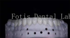 Quality OEM ODM Stain Resistant Natural Looking Porcelain Veneers High Strength wholesale
