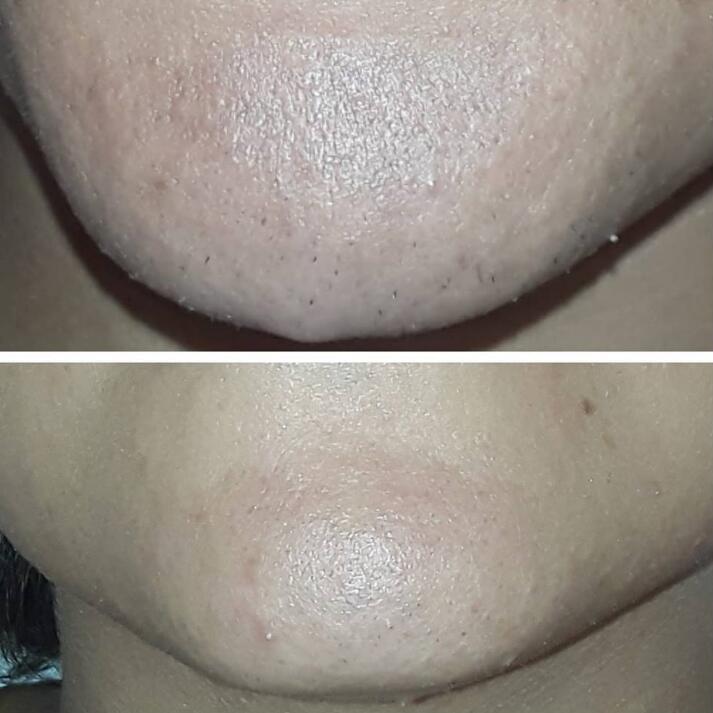 Professional Portable Hair Removal Laser Machine For Salon / Home