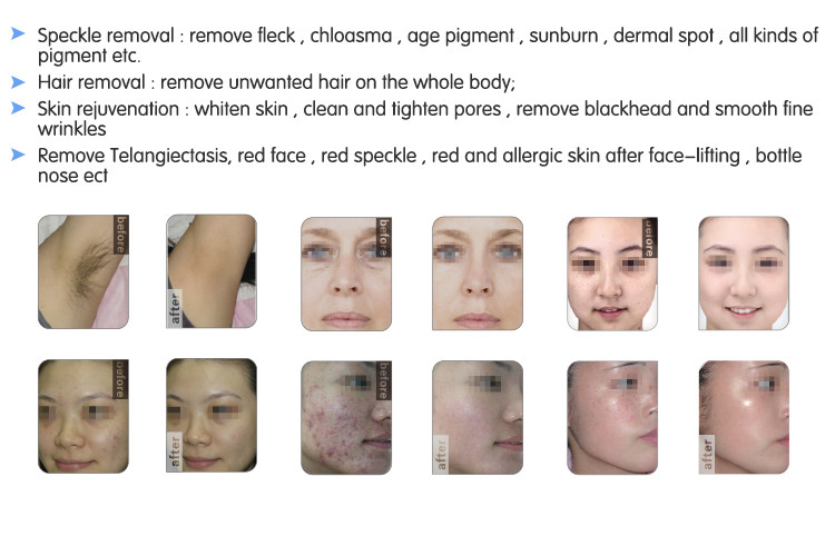 Big Discount!!! CE / FDA beauty multifunctional 3 in 1 SHR+Elight+IPL hair removal ,skin rejuvenation machine