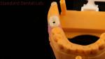 Dental Implant Screw Retained Crown PFZ Porcelain Layered Zirconia With 3D Print