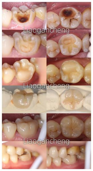 Porcelain Dental Inlay Restorative For Adults And Children Exceptional