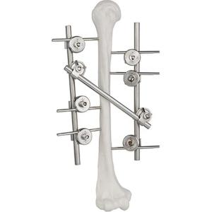 Quality Titanium Humeral External Fixation Device Orthopedic Surgical Implant wholesale