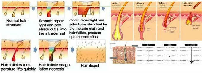 Customized SHR IPL Laser Parts Laser Hair Removal Semiconductor Handle Heat Treatment