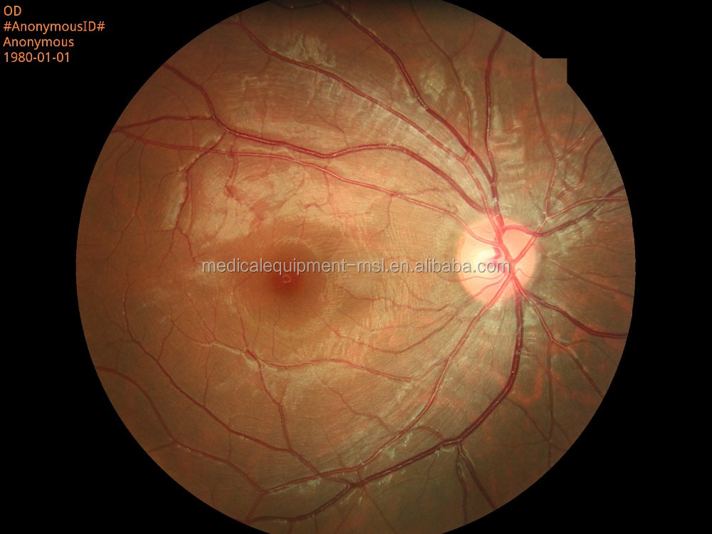 Portable Digital Fundus Camera with Ce Approval (HA06)