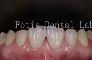 Quality Polishing Synthetic Dental Laminate Veneers High Stain Resistance wholesale