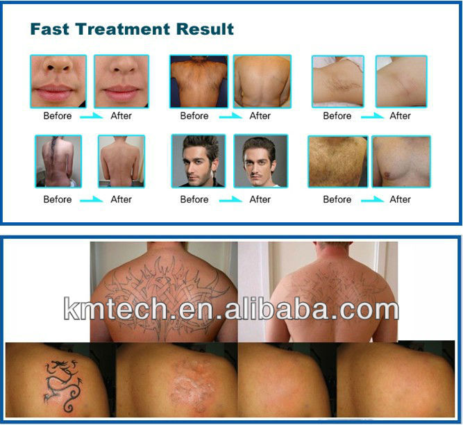 Beauty Salon IPL Laser Machine Hair Removal RF Skin Care Tattoo Removal