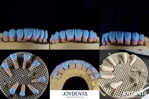 Quality High Biocompatibility Feldspathic Ceramic Veneer Glossy For Dental Restorations wholesale