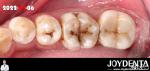 Natural Color Accurate Fit Dental Inlay For Damaged Teeth Restoration
