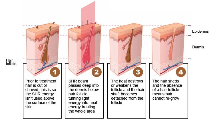 CE Approved Facial Equipment Intense Pulse Light OPT IPL Laser Hair Removal Device