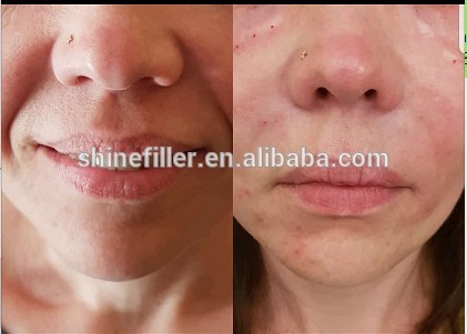 Clinic Injectable Dermal Filler , Transparent Hyaluronic Acid Injection