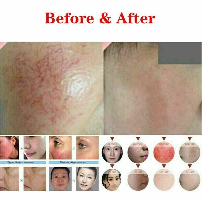 Professional 30W Laser Beauty Machine 980nm Diode Laser Spider Vascular Vein Removal