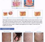 Stationary Fractional Laser Co2 Machine Scar Removal Infrared Skin