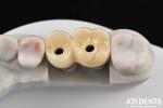 Customizable Porcelain Dental Implant Supported Bridge And Crown For Exceptional