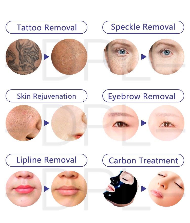 DPL Professional picosecond pigmentation skin care 1064 755 laser nd yag q-switched system nd yag laser 2022